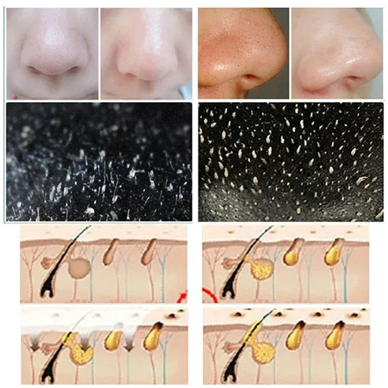 10pcs Blackhead Nose Strips
